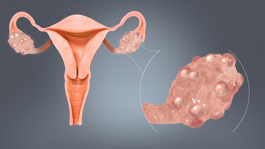 Lire la suite à propos de l’article Remède Naturel Dystrophie Ovarienne Causes Symptômes