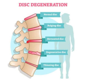 Read more about the article Discopathie Dégénérative Traitement Causes Symptômes