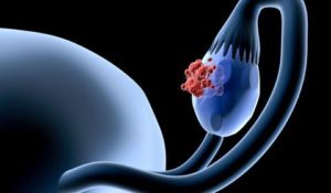 Lire la suite à propos de l’article Comment Traiter le Cancer des Ovaires