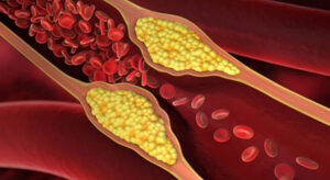 Lire la suite à propos de l’article Hypercholestérolémie Traitement Naturel Cause Symptome