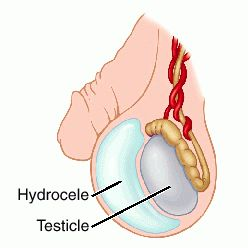 Plantes contre l’hydrocèle testiculaire
